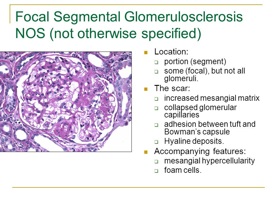 گلومرولواسکروز کانونی ـ قطعهای focal segmental glomerulosclerosis