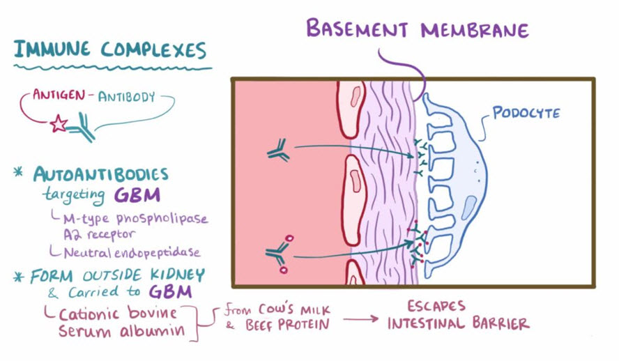 گلومرولونفریت غشایی membranous glomerulonephritis