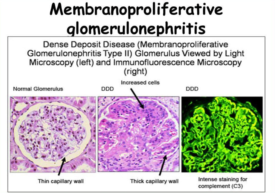 گلومرولونفریت با تکثیر غشایی membranoproliferative glomerulonephritis