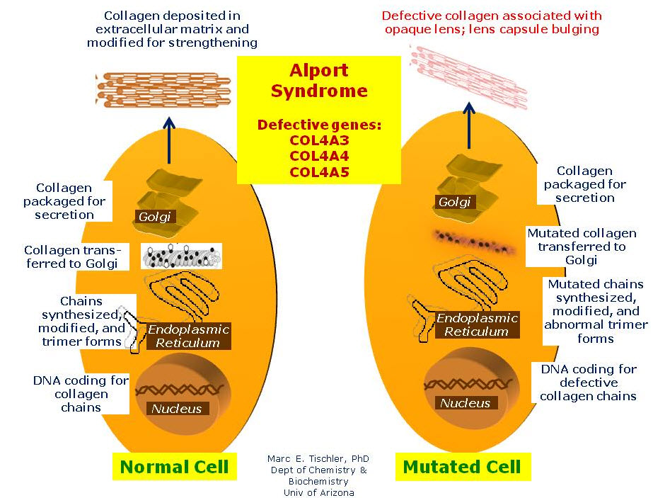 سندرم آلپورت alport syndrome