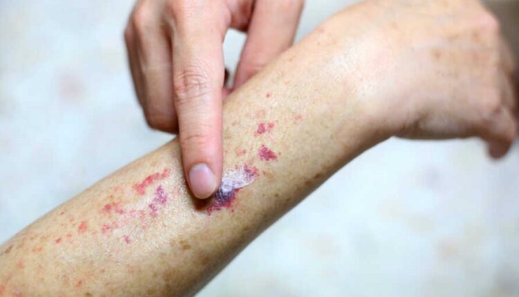 Thrombocytopenia