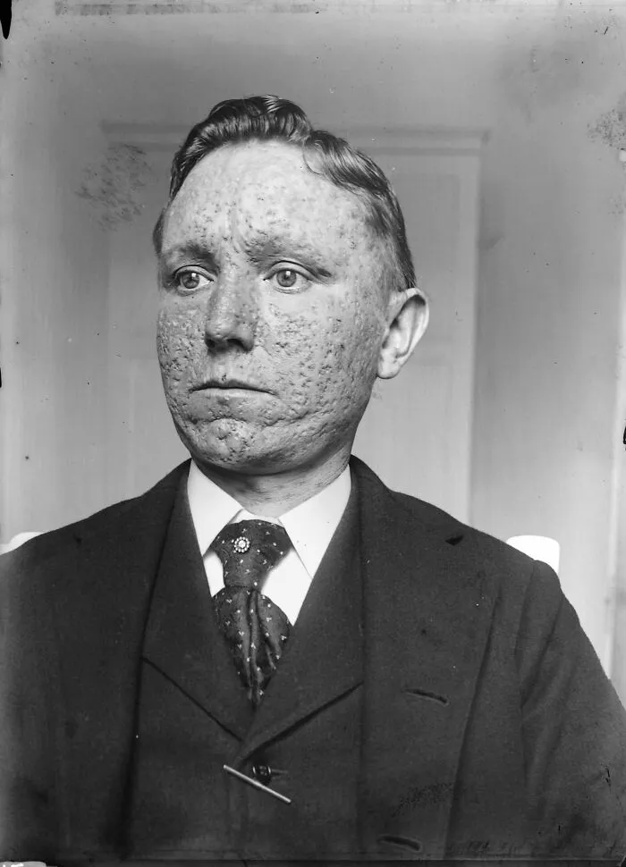 مردی بهبودیافته از آبله با جای زخم دائمی روی صورت | Smallpox survivor with permanent facial scars