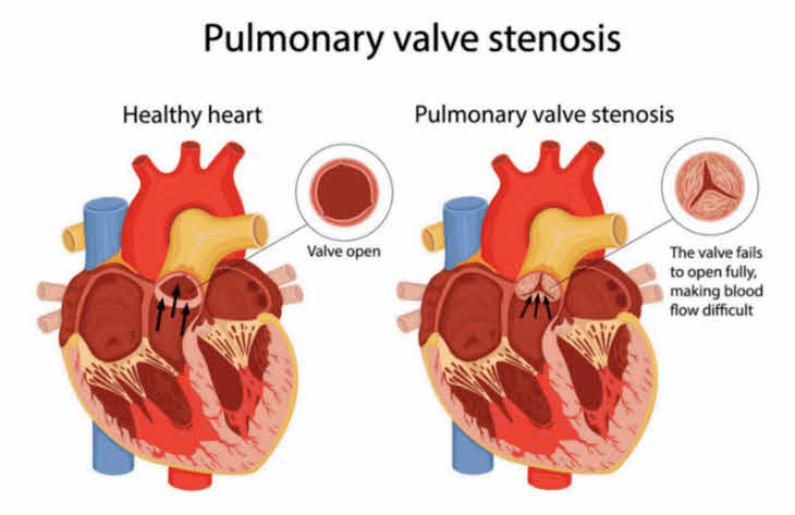 تنگی دریچه ریوی (Pulmonary Valve Stenosis)