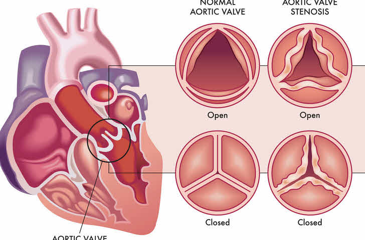 تنگی دریچه آئورت (Aortic Stenosis)