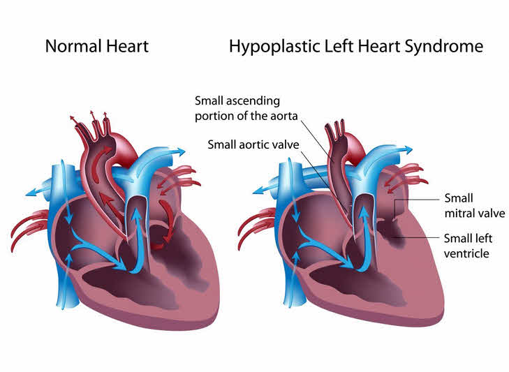 سندرم قلب چپ هیپوپلاستیک (Hypoplastic Left Heart Syndrome یا HLHS)