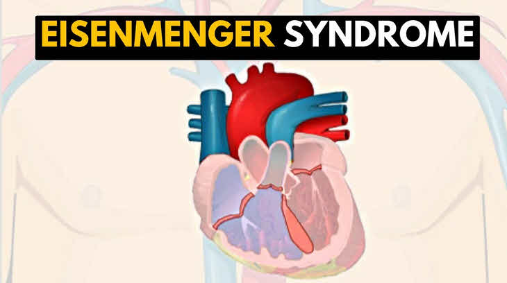 سندرم آیزن‌منگر (Eisenmenger Syndrome)