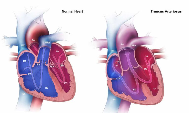 تنه واحد شریانی (Truncus Arteriosus)