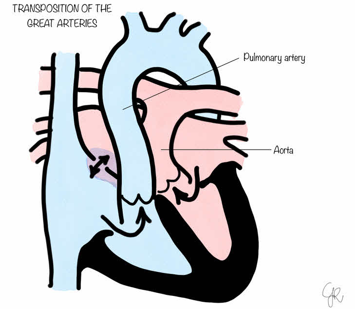 جابجایی عروق بزرگ (Transposition of the Great Arteries - TGA)