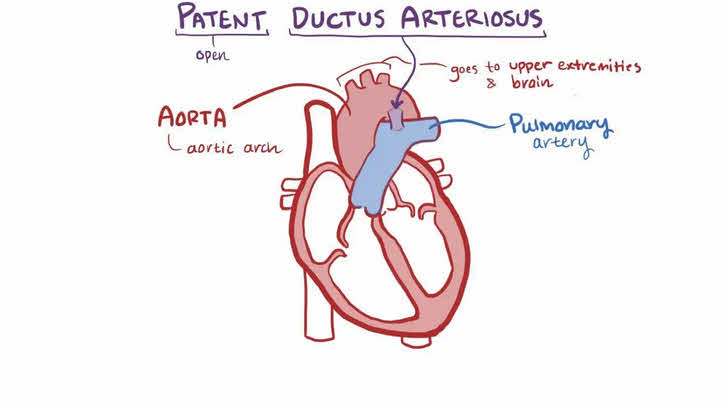 مجرای شریانی باز (Patent Ductus Arteriosus - PDA)