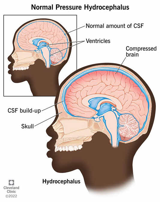 هیدروسفالی با فشار طبیعی (Normal Pressure Hydrocephalus - NPH)