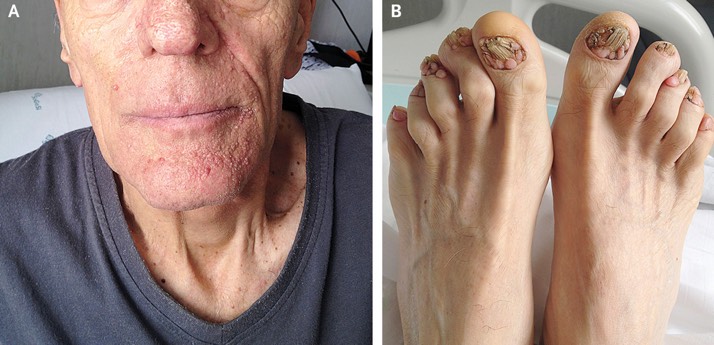 بیماری توبروس اسکلروزیس (Tuberous Sclerosis)