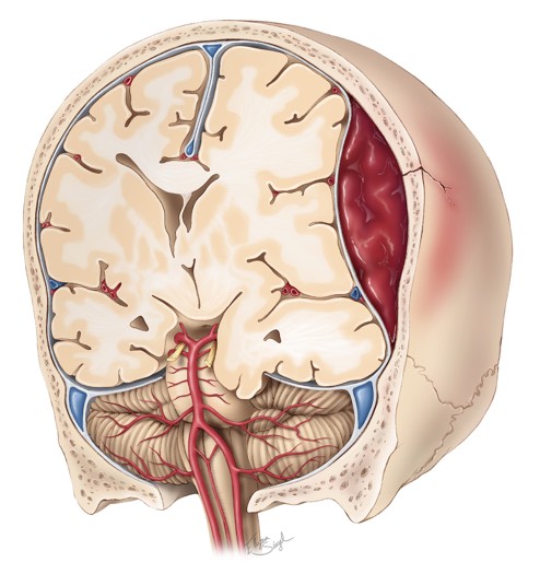 هماتوم اپی‌دورال (Epidural Hematoma)