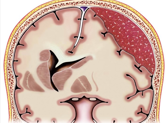 هماتوم ساب‌دورال (Subdural Hematoma)