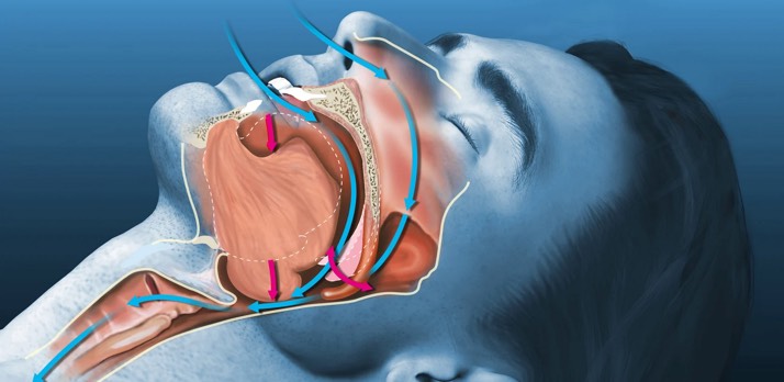 آپنه انسدادی خواب (Obstructive Sleep Apnea - OSA)