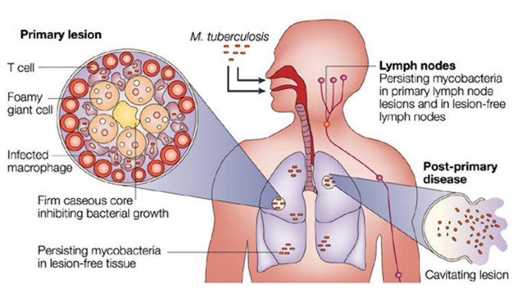 Mycobacterium Tuberculosis Infection