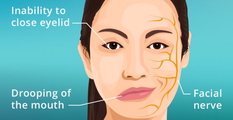 فلج بل (Bell's Palsy)