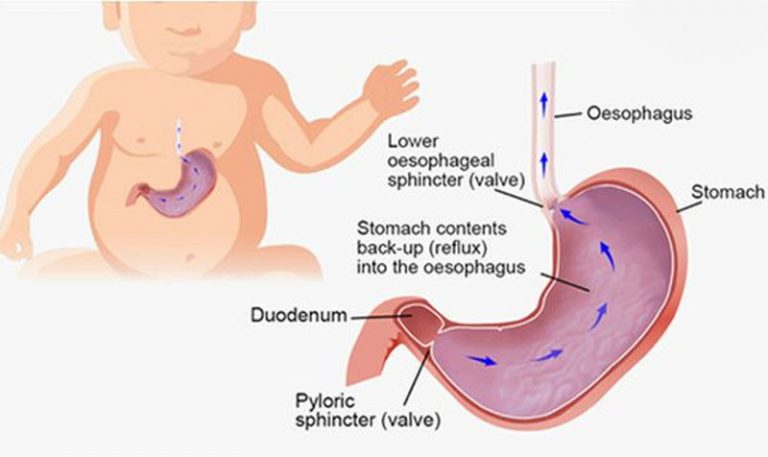 Infant reflux