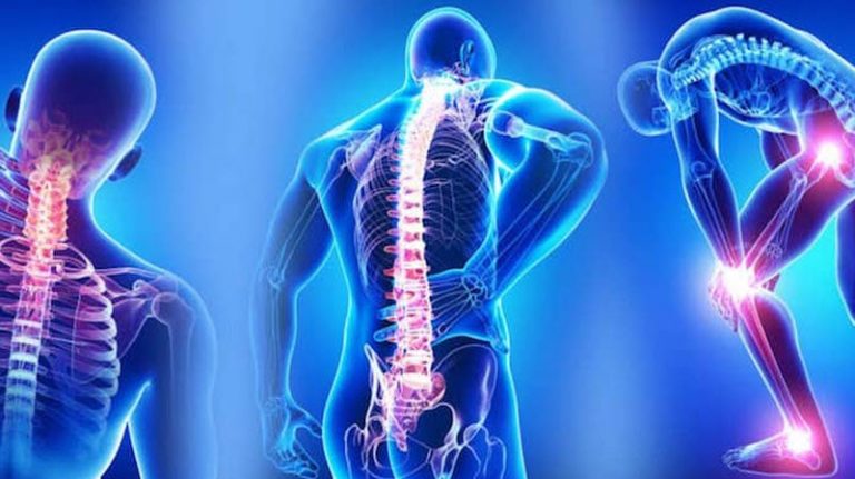 فیبرومیالژی (Fibromyalgia)