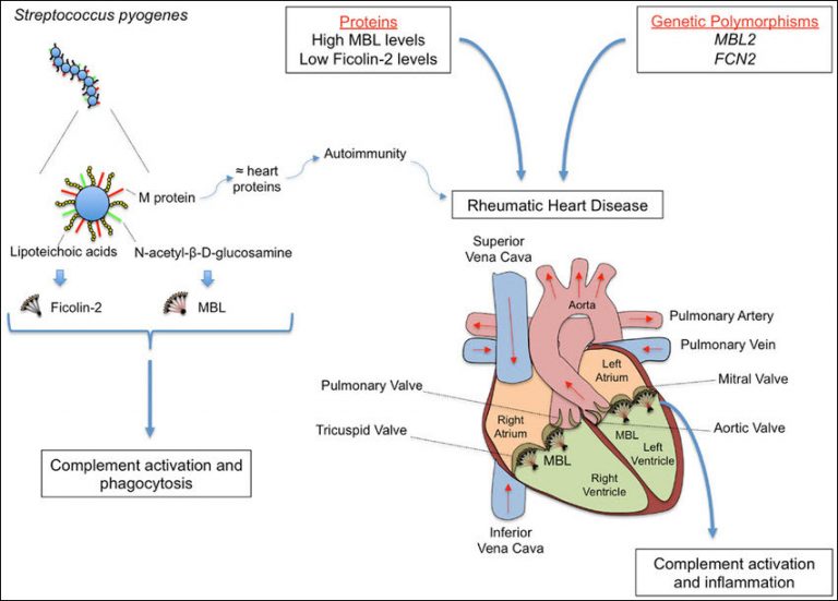 Rheumatic fever