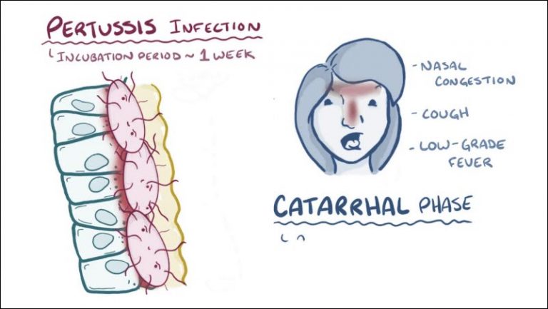 pertussis