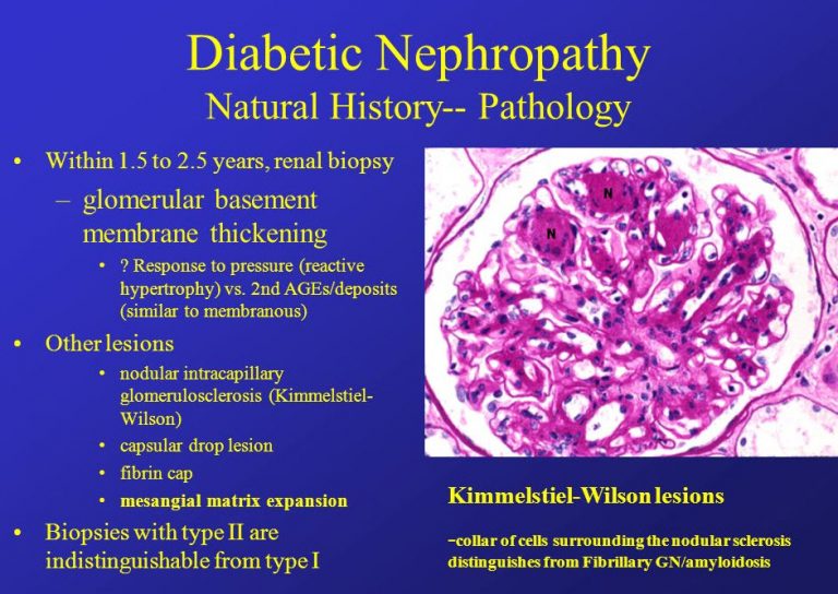 نفروپاتی دیابتی diabetic nephropathy