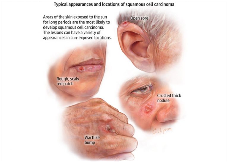 Squamous cell carcinoma