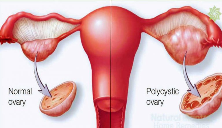 Polycystic ovary syndrome
