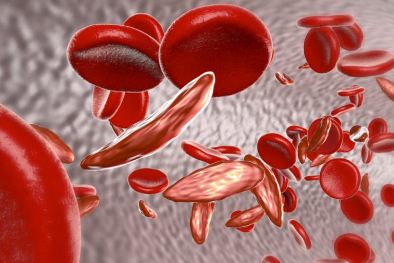 sickle cell anemia