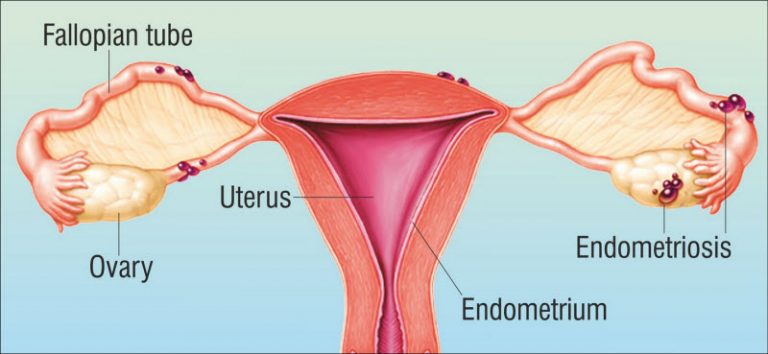 Endometriosis