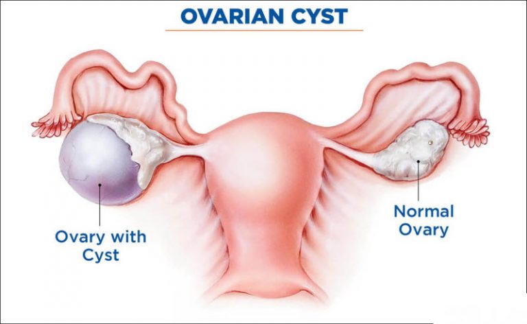 Ovarian cysts