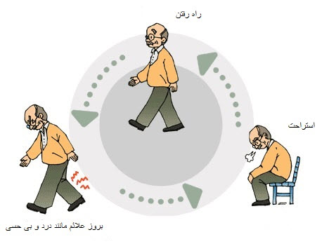 ایجاد علائم تنگی کانال نخاع در راه رفتن