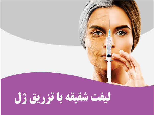 تصویر لیفت شقیقه با تزریق ژل