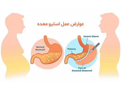 عوارض اسلیو معده