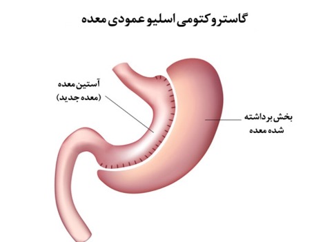اسلیو معده