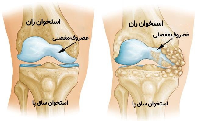 استخوان ریزه در زانو