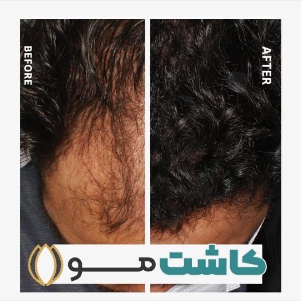 کاشت مو با سلول های بنیادی