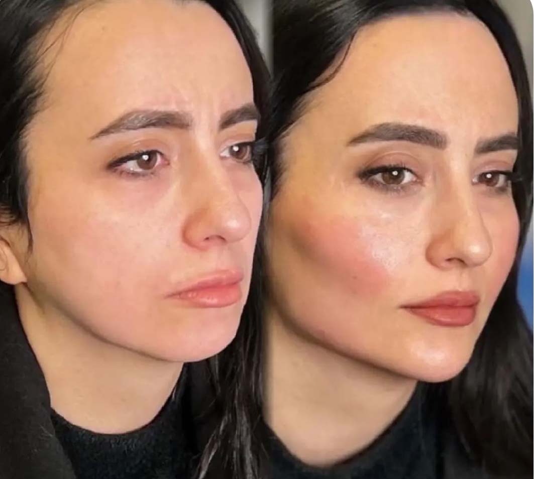 کانتورینگ صورت با تزریق ژل