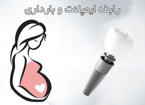 ایمپلنت و بارداری