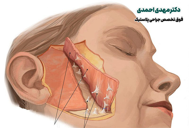 بهترین دکتر لیفت صورت