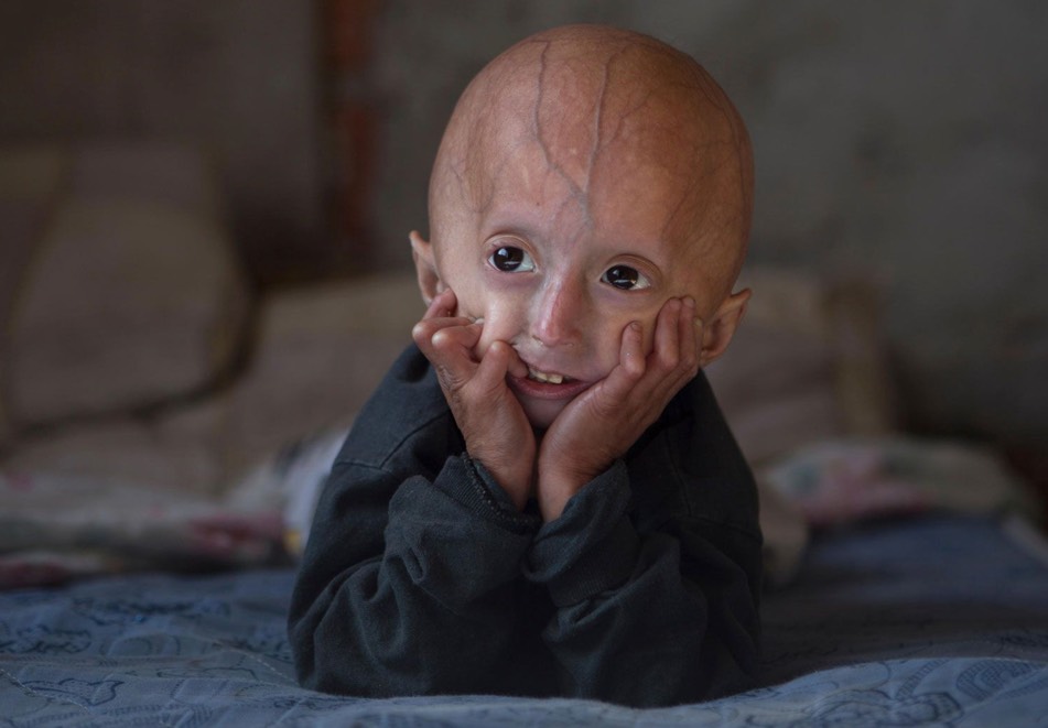 اختلال پزشکی ژنتیکی نادر و عجیب