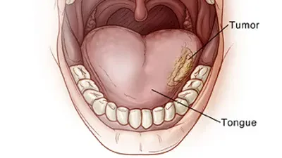 علائم سرطان زبان