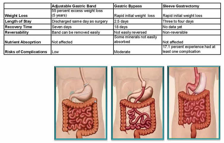 Stomach Surgeries for Weight Loss