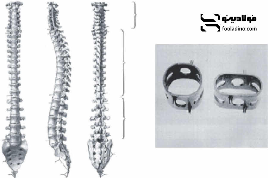 نایتینول برای کاربردهای ارتوپدی