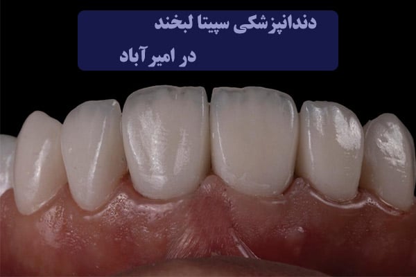 لمینت سرامیکی سپیتا لبخند