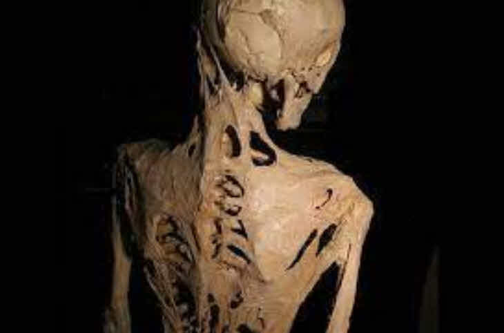 Stone Man Syndrome (Fibrodysplasia Ossificans Progressiva)