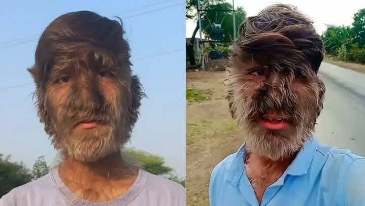 Werewolf Syndrome (Hypertrichosis)