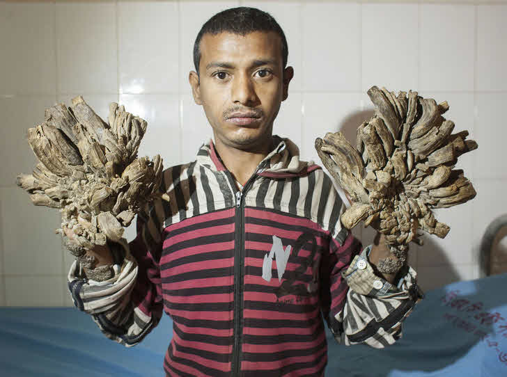 Tree Bark Skin Disorder (Epidermodysplasia Verruciformis)