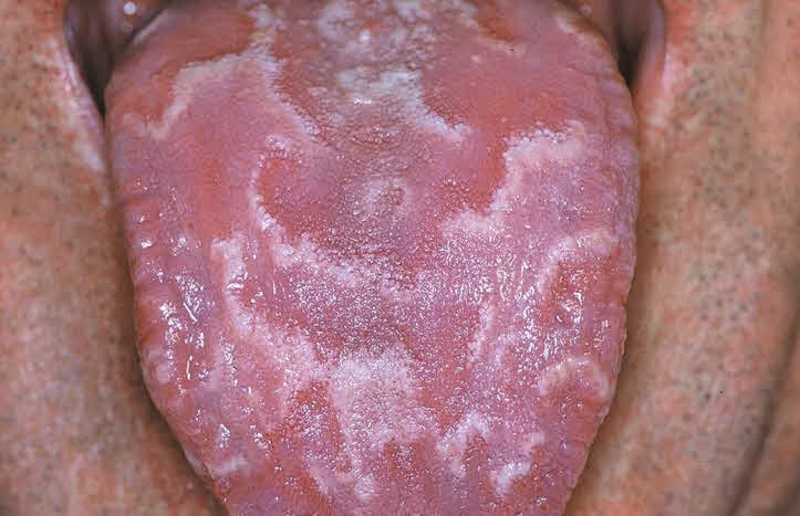 Geographic Tongue (Benign Migratory Glossitis)