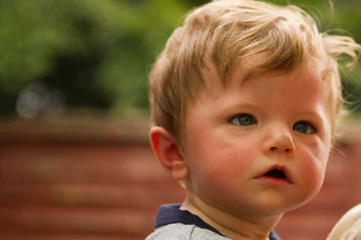 Moebius Syndrome