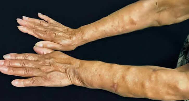 Dercum's Disease (Adiposis Dolorosa)